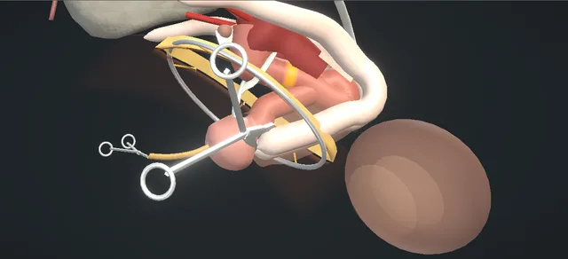 Operative plate: Male urethrectomy