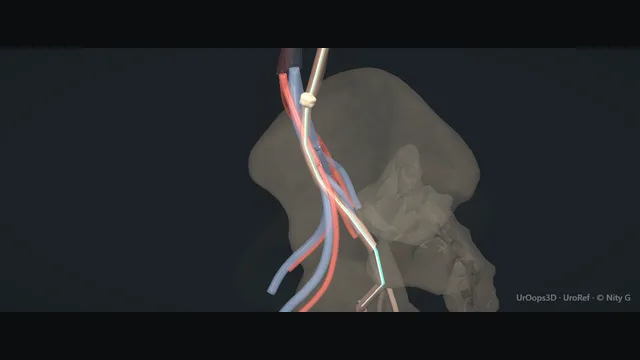 Operative plate: Ureteroscopy + laser