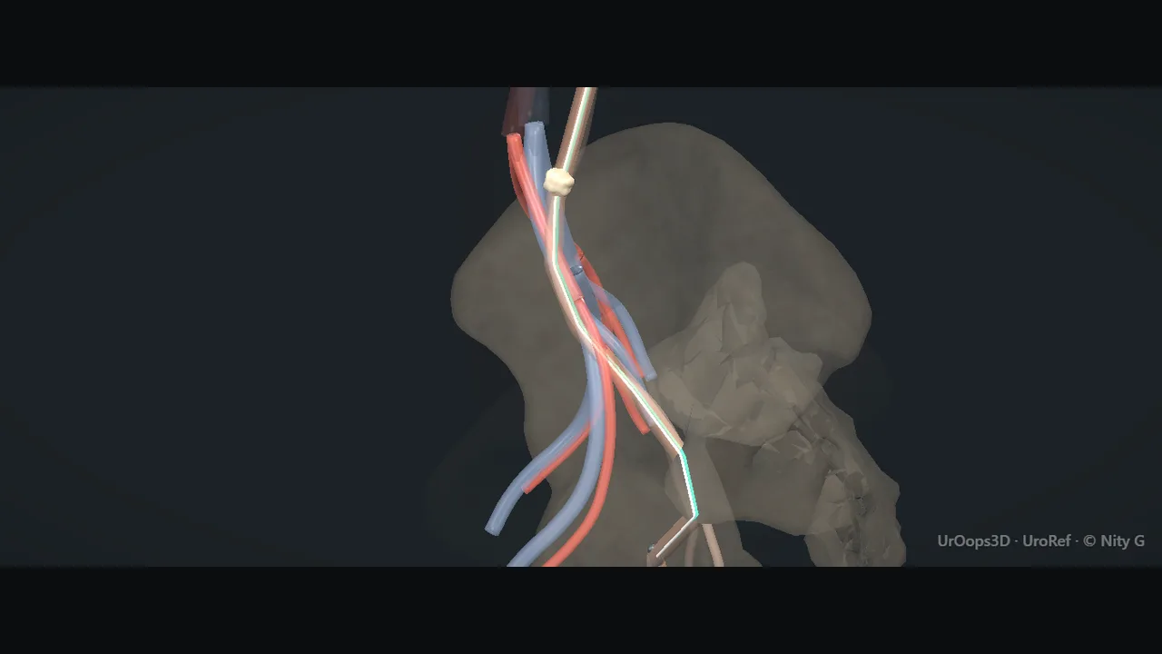 Semirigid ureteroscope view: the wire running under a tented ridge of mucosa