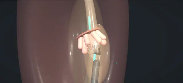 Operative plate: Ureteroscopy for upper-tract tumour