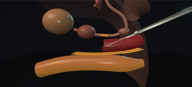 Operative plate: Penile inversion vaginoplasty