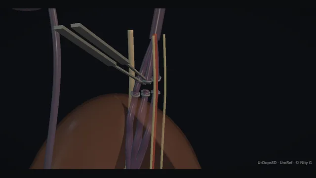 Operative plate: Varicocele: coil or ligature