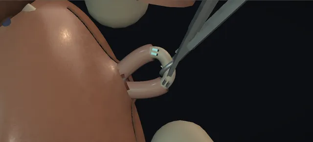 Operative plate: Vasectomy: no-scalpel