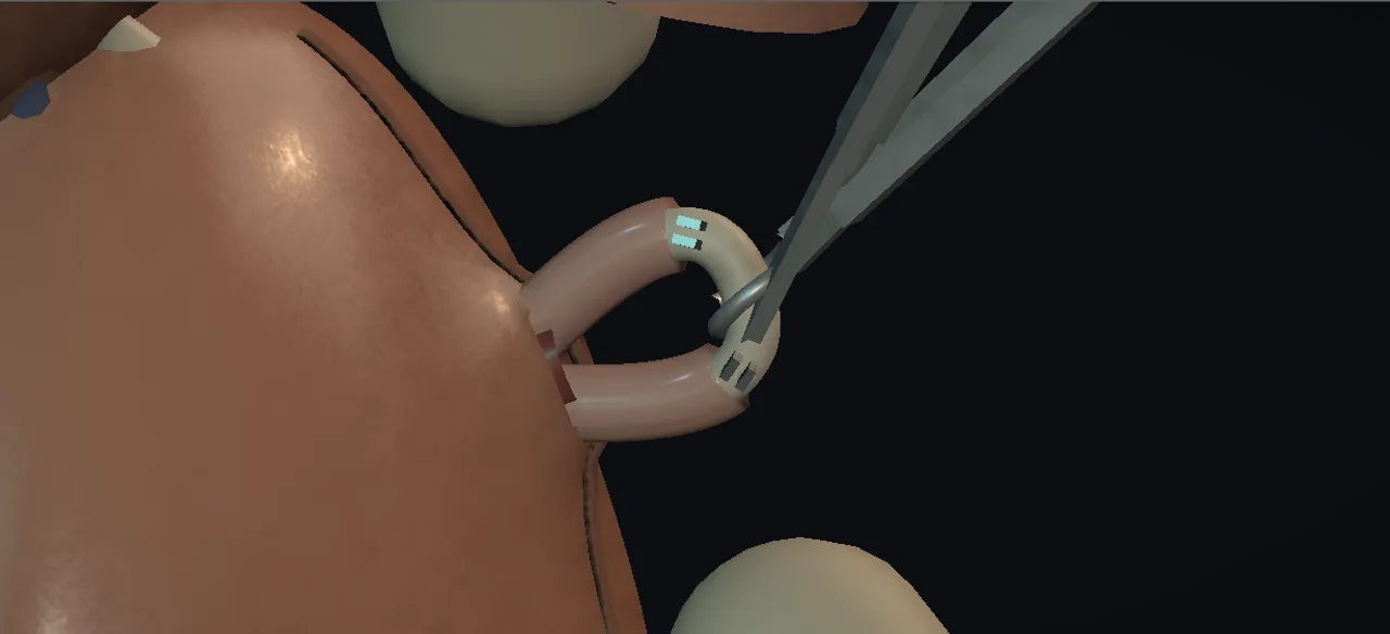 Rendered frame from the Interactive vasectomy (no-scalpel)