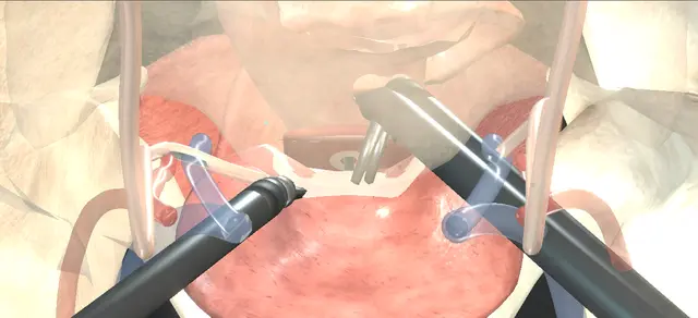 Operative plate: Robotic vesicovaginal fistula repair
