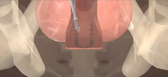 Operative plate: Vesicovaginal fistula repair, transvaginal