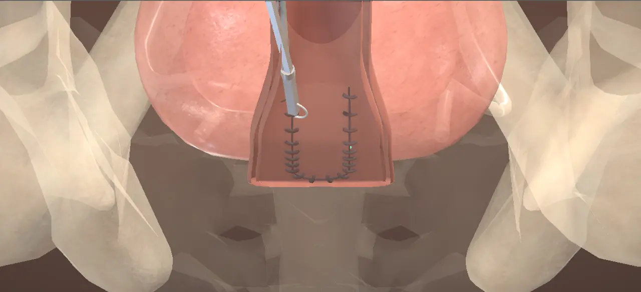Rendered frame from the Interactive transvaginal repair