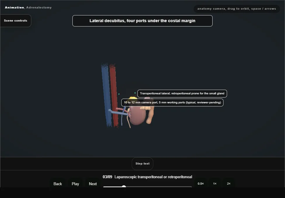 Adrenalectomy. Step 3: Laparoscopic transperitoneal or retroperitoneal. Captured frame from the interactive animation.