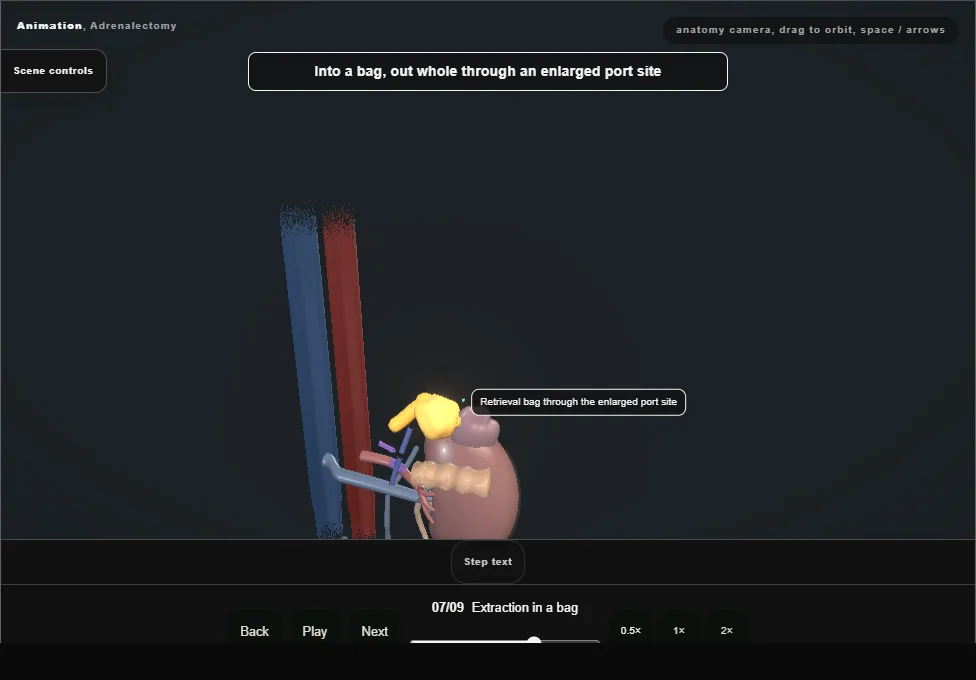 Adrenalectomy. Step 7: Extraction in a bag. Captured frame from the interactive animation.