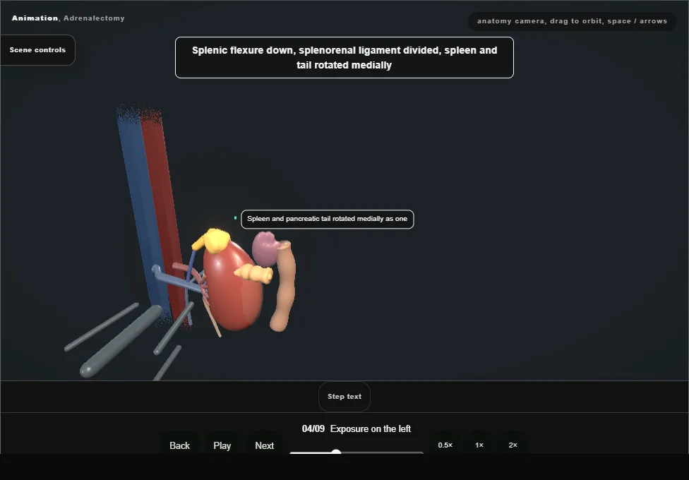 Adrenalectomy. Step 4: Exposure on the left. Captured frame from the interactive animation.