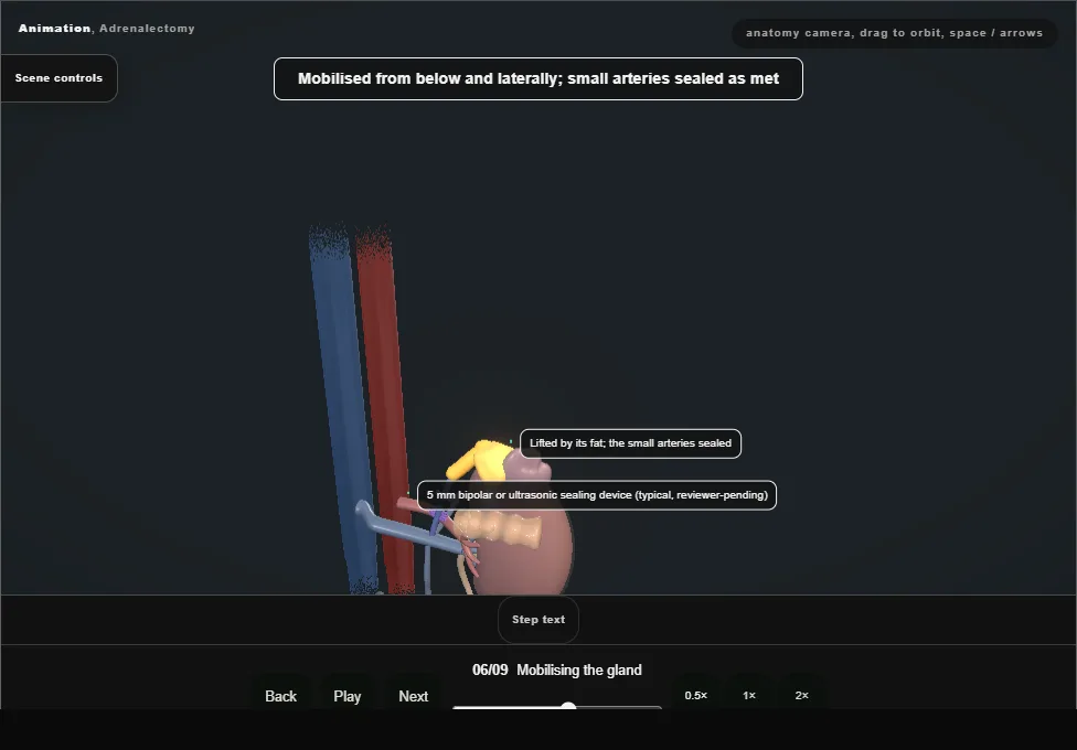 Adrenalectomy. Step 6: Mobilising the gland. Captured frame from the interactive animation.