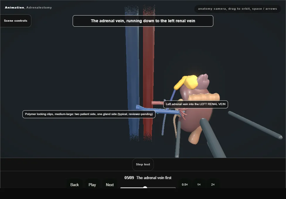 Adrenalectomy. Step 5: The adrenal vein first. Captured frame from the interactive animation.