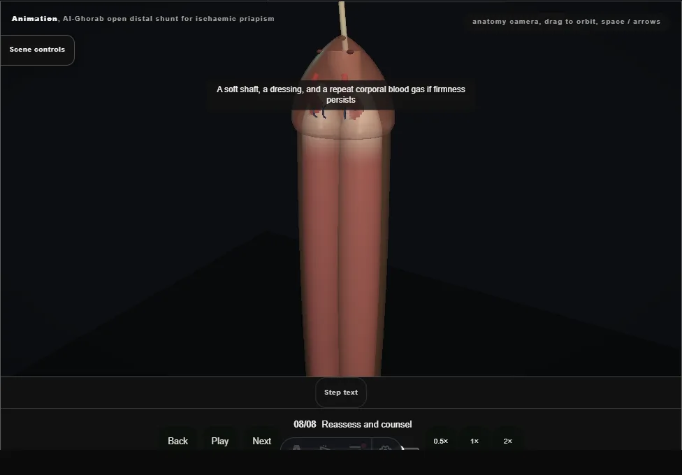 Al-Ghorab open distal shunt for ischaemic priapism. Step 8: Reassess and counsel. Captured frame from the interactive animation.