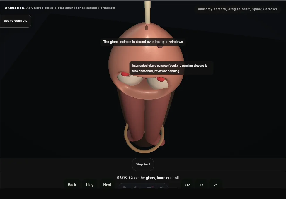 Al-Ghorab open distal shunt for ischaemic priapism. Step 7: Close the glans; tourniquet off. Captured frame from the interactive animation.