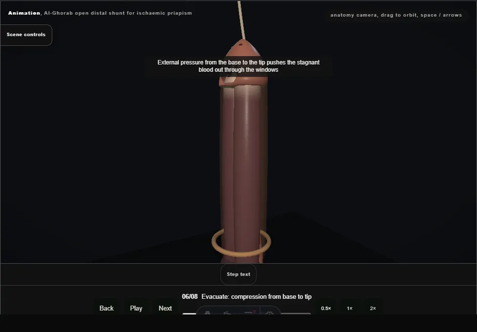 Al-Ghorab open distal shunt for ischaemic priapism. Step 6: Evacuate: compression from base to tip. Captured frame from the interactive animation.