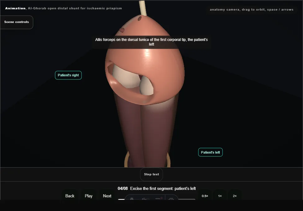 Al-Ghorab open distal shunt for ischaemic priapism. Step 4: Excise the first segment: patient's left. Captured frame from the interactive animation.