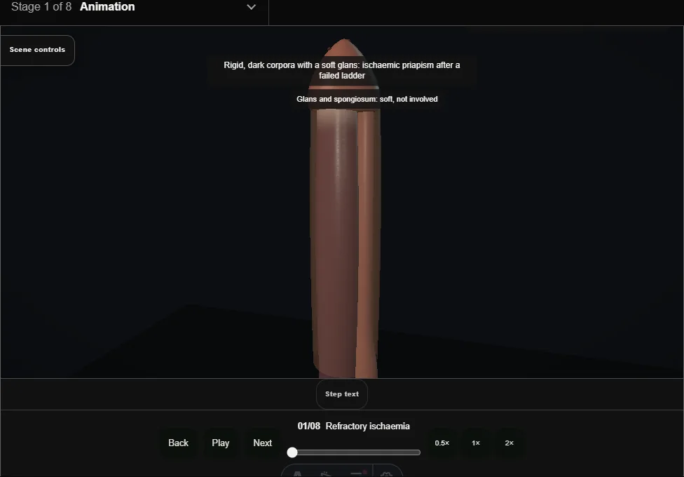 Al-Ghorab open distal shunt for ischaemic priapism. Step 1: Refractory ischaemia. Captured frame from the interactive animation.