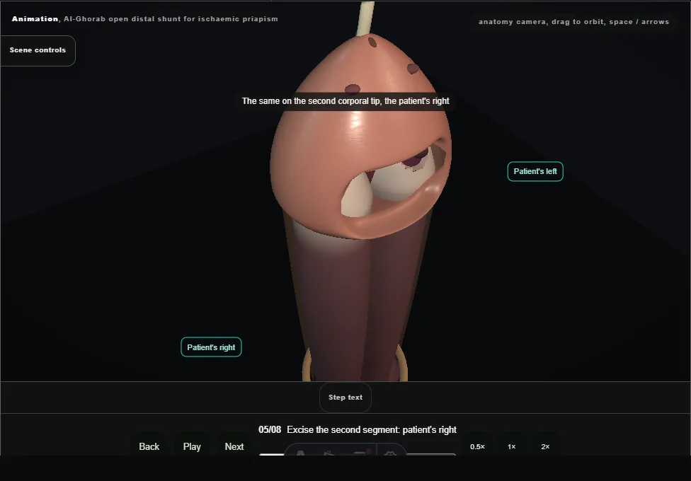 Al-Ghorab open distal shunt for ischaemic priapism. Step 5: Excise the second segment: patient's right. Captured frame from the interactive animation.