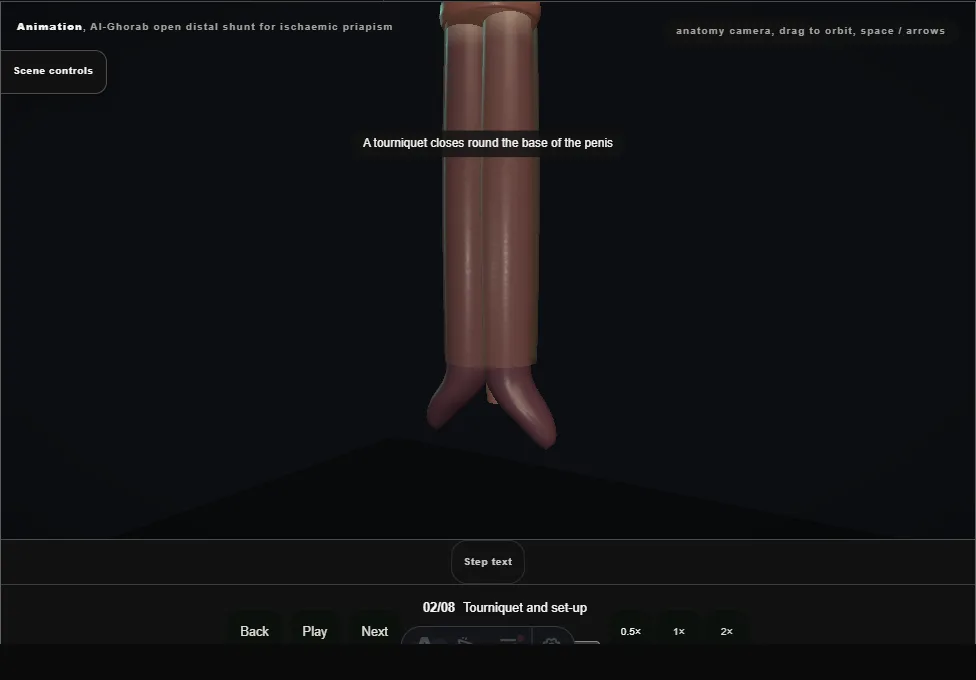 Al-Ghorab open distal shunt for ischaemic priapism. Step 2: Tourniquet and set-up. Captured frame from the interactive animation.