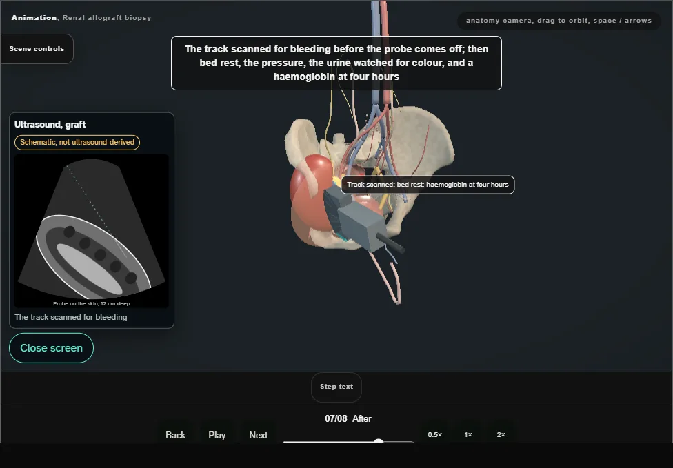 Renal allograft biopsy. Step 7: After. Captured frame from the interactive animation.