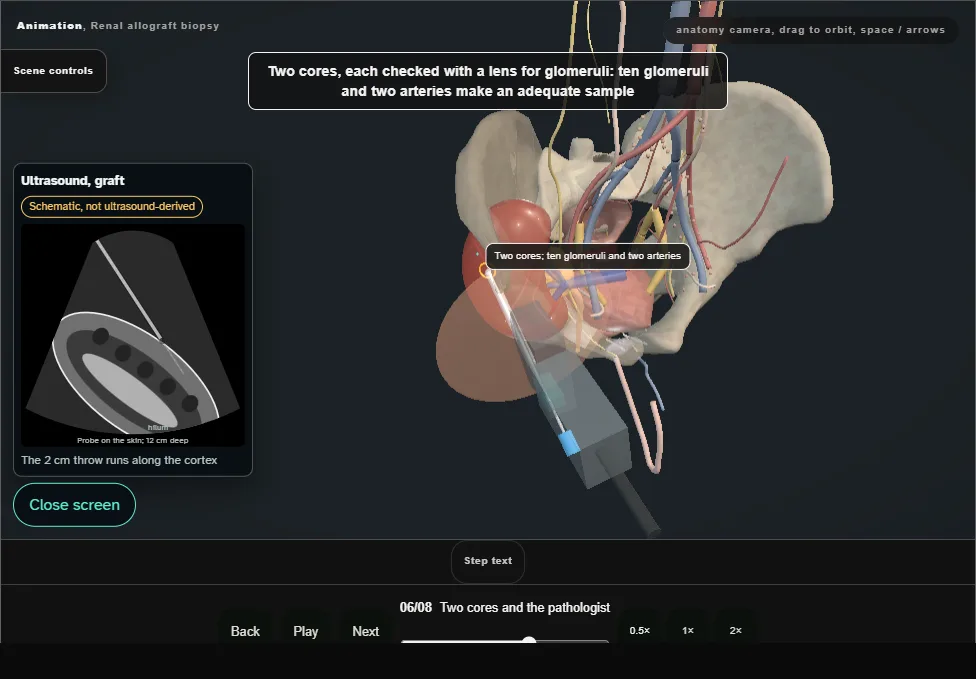 Renal allograft biopsy. Step 6: Two cores and the pathologist. Captured frame from the interactive animation.