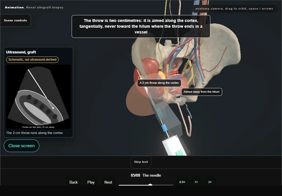 Renal allograft biopsy. Step 5: The needle. Captured frame from the interactive animation.
