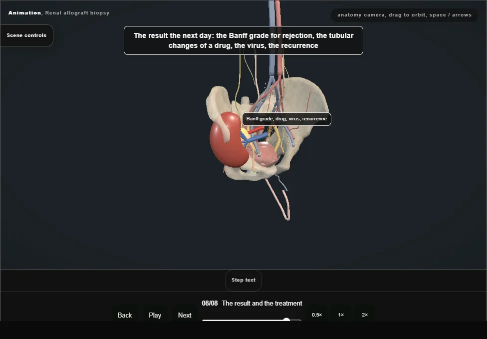 Renal allograft biopsy. Step 8: The result and the treatment. Captured frame from the interactive animation.