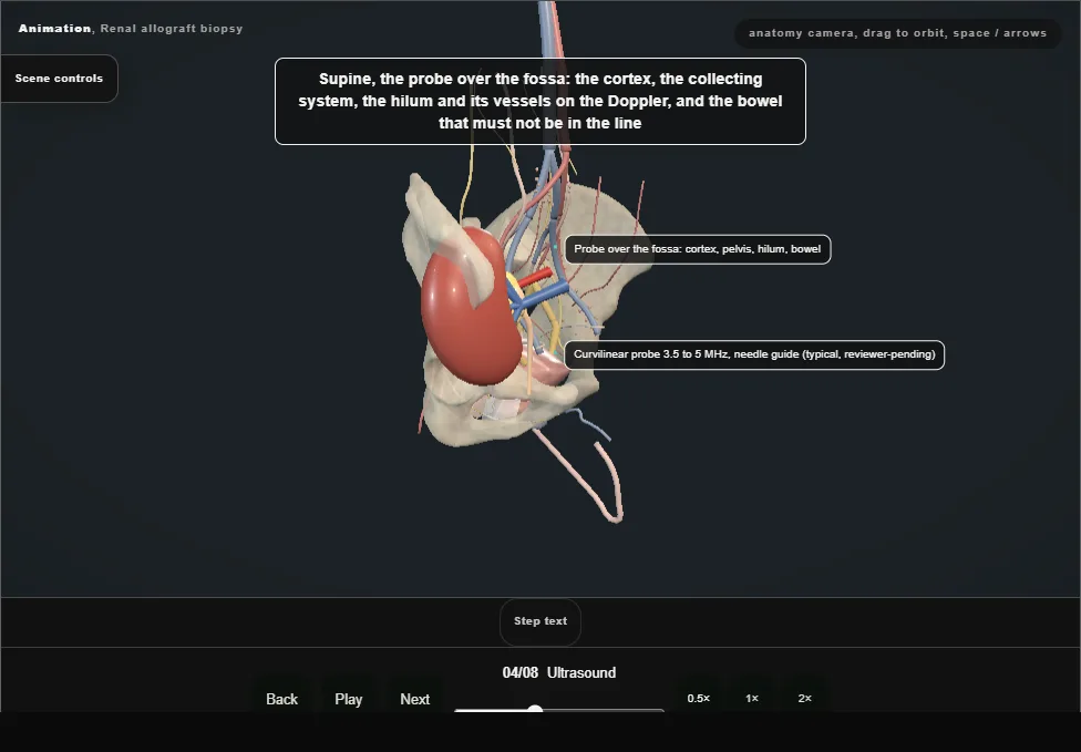 Renal allograft biopsy. Step 4: Ultrasound. Captured frame from the interactive animation.