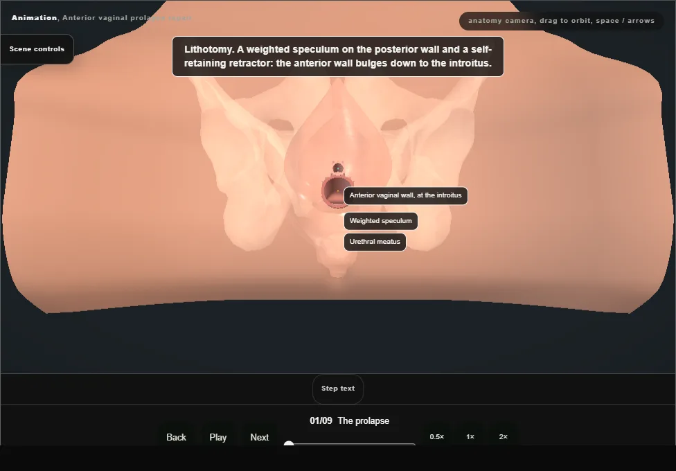Anterior vaginal prolapse repair. Step 1: The prolapse. Captured frame from the interactive animation.