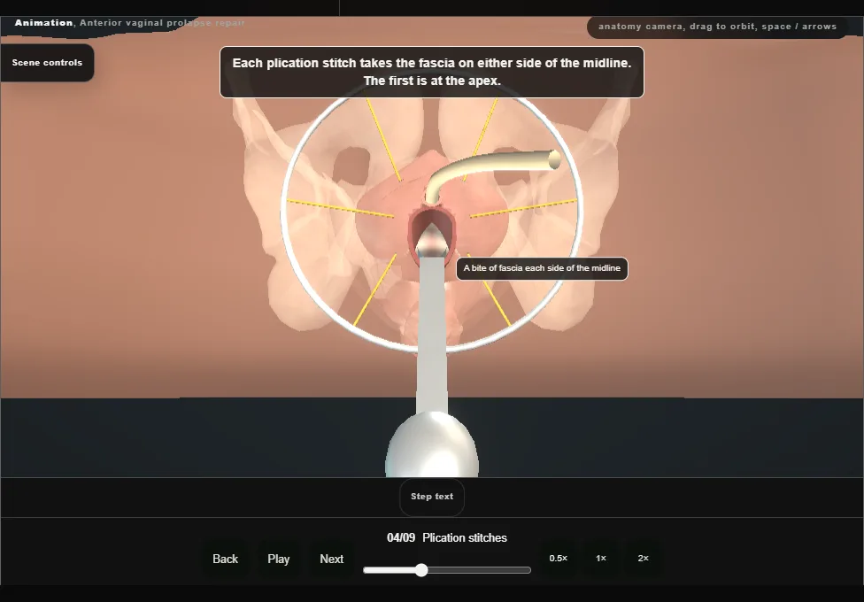 Anterior vaginal prolapse repair. Step 4: Plication stitches. Captured frame from the interactive animation.