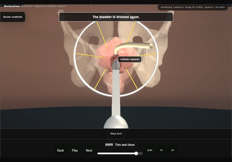 Anterior vaginal prolapse repair. Step 9: Trim and close. Captured frame from the interactive animation.
