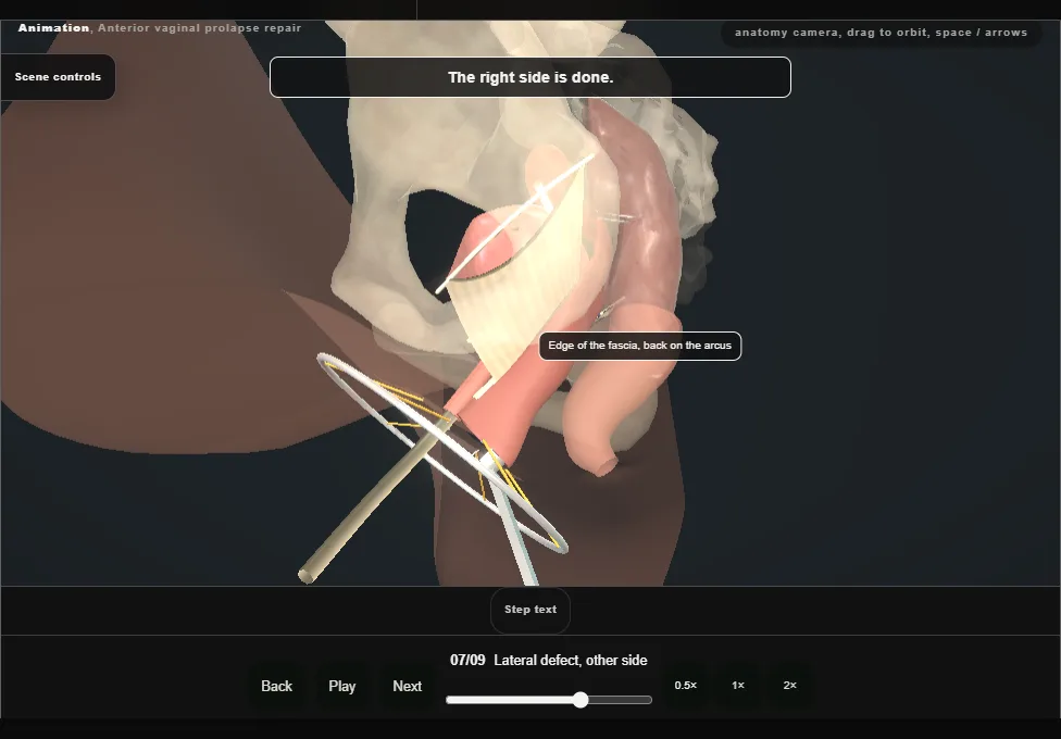 Anterior vaginal prolapse repair. Step 7: Lateral defect, other side. Captured frame from the interactive animation.