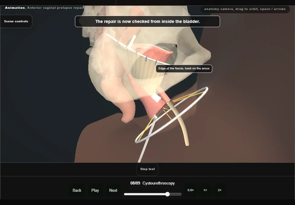 Anterior vaginal prolapse repair. Step 8: Cystourethroscopy. Captured frame from the interactive animation.