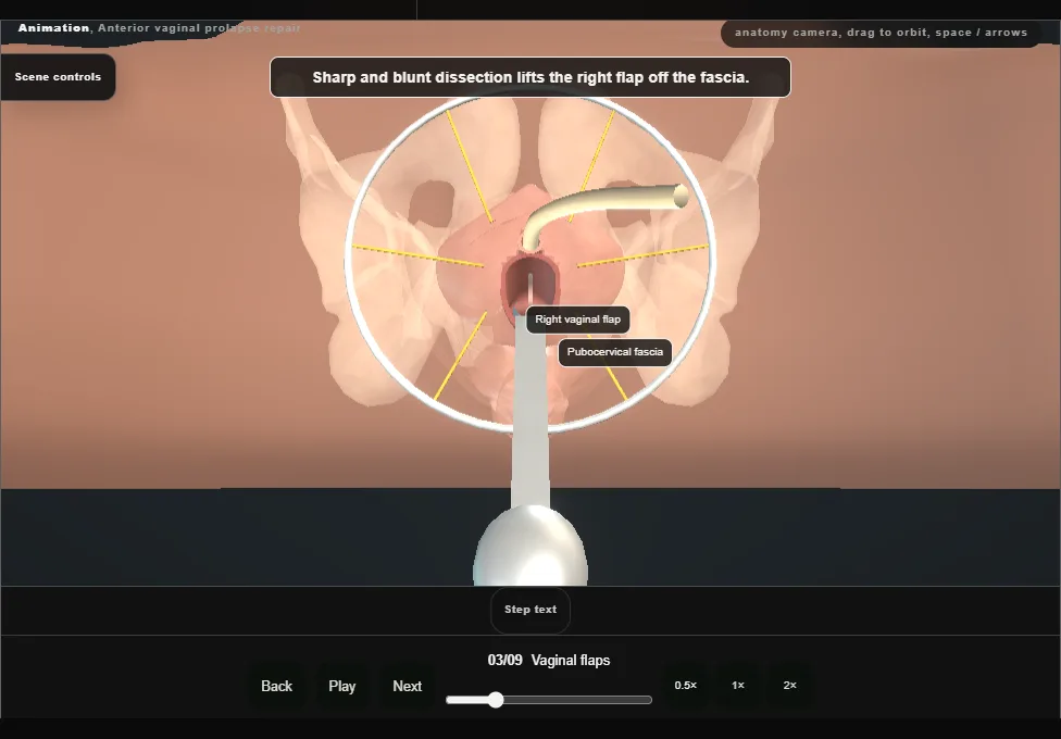 Anterior vaginal prolapse repair. Step 3: Vaginal flaps. Captured frame from the interactive animation.