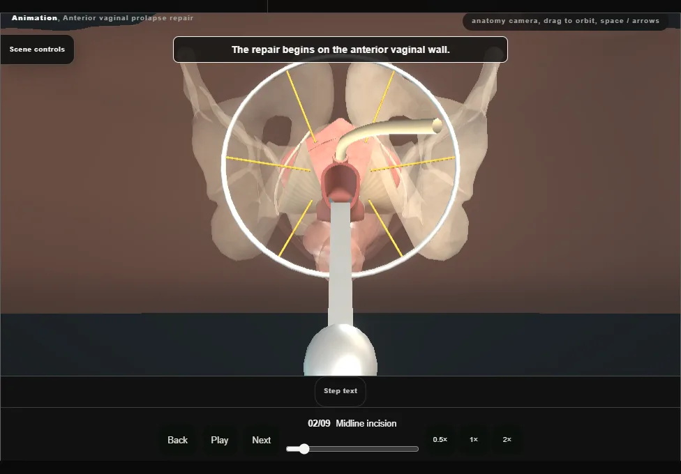 Anterior vaginal prolapse repair. Step 2: Midline incision. Captured frame from the interactive animation.