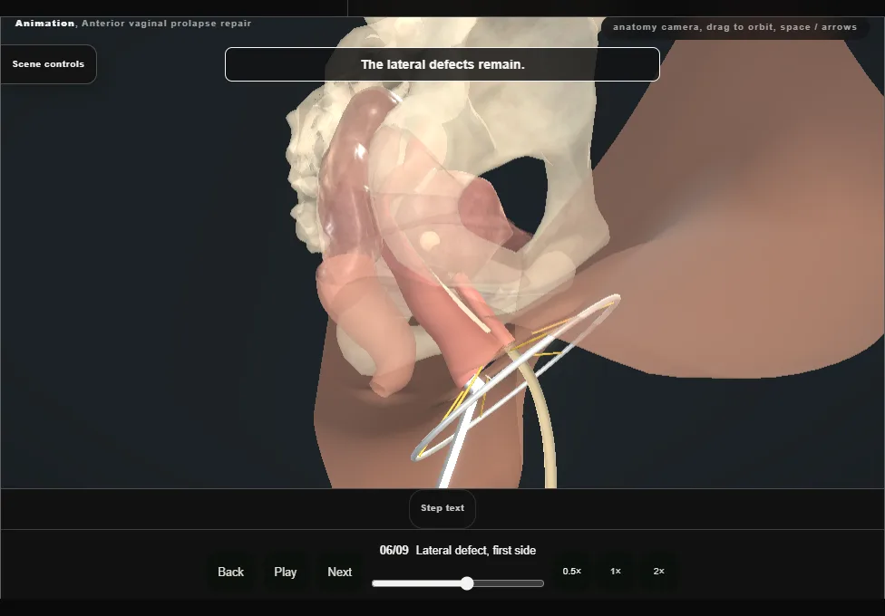 Anterior vaginal prolapse repair. Step 6: Lateral defect, first side. Captured frame from the interactive animation.