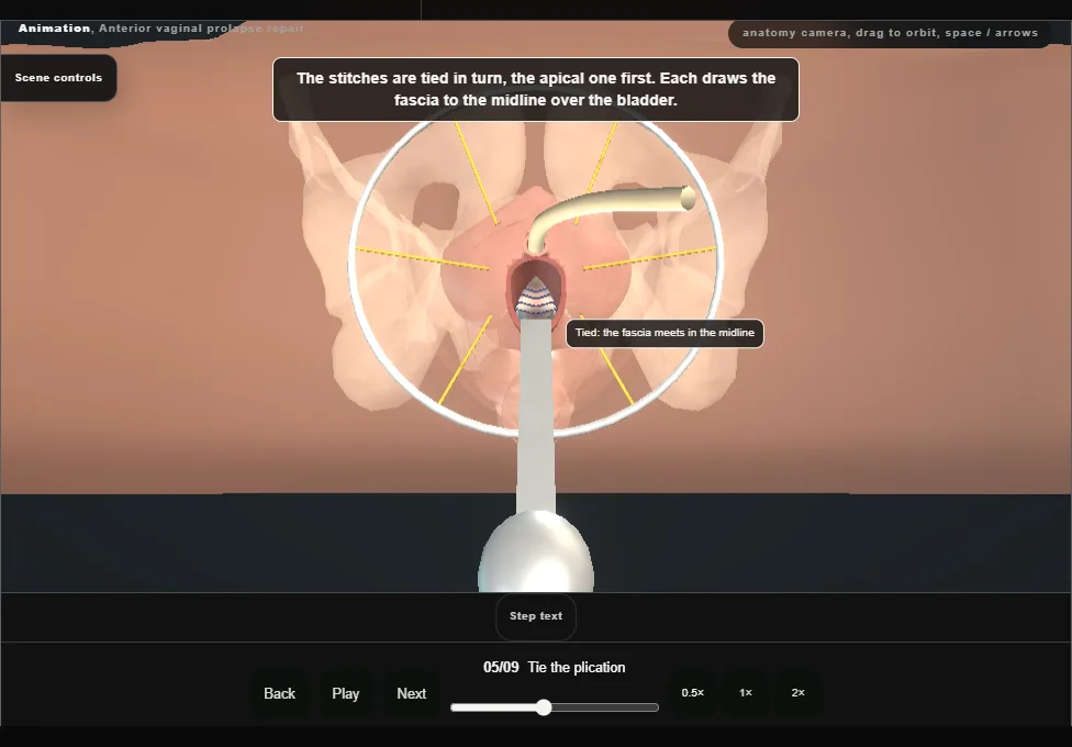Anterior vaginal prolapse repair. Step 5: Tie the plication. Captured frame from the interactive animation.