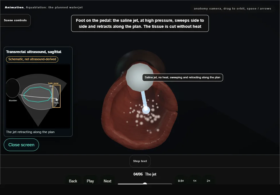 Aquablation: the planned waterjet. Step 4: The jet. Captured frame from the interactive animation.