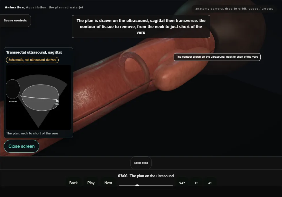 Aquablation: the planned waterjet. Step 3: The plan on the ultrasound. Captured frame from the interactive animation.