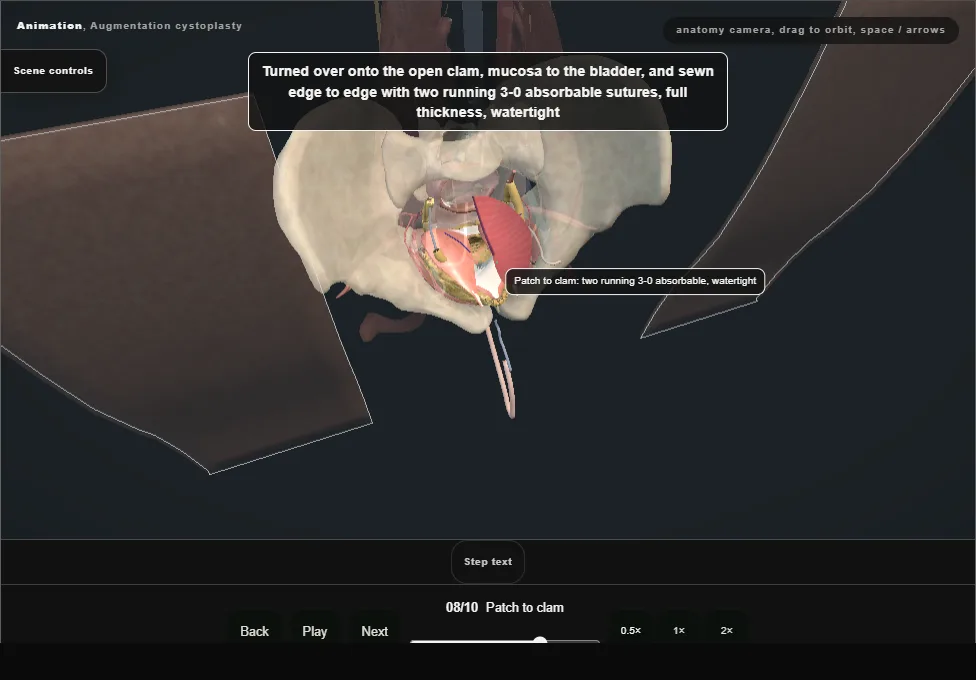 Augmentation cystoplasty. Step 8: Patch to clam. Captured frame from the interactive animation.