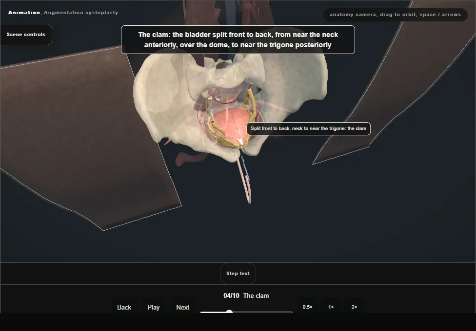 Augmentation cystoplasty. Step 4: The clam. Captured frame from the interactive animation.