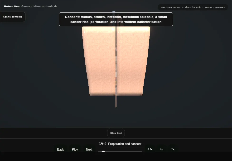 Augmentation cystoplasty. Step 2: Preparation and consent. Captured frame from the interactive animation.