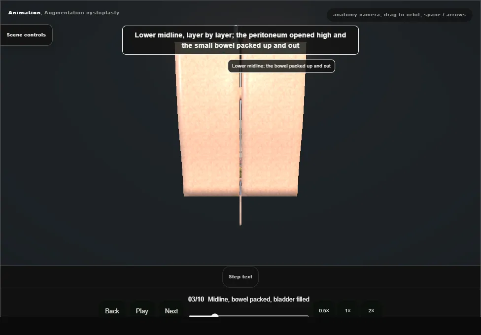 Augmentation cystoplasty. Step 3: Midline, bowel packed, bladder filled. Captured frame from the interactive animation.