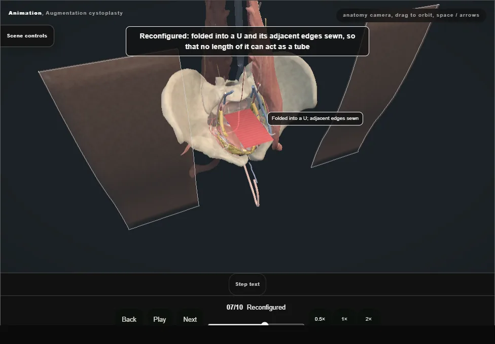 Augmentation cystoplasty. Step 7: Reconfigured. Captured frame from the interactive animation.