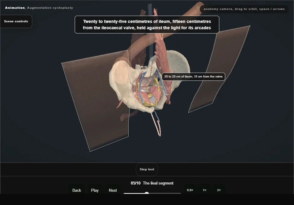 Augmentation cystoplasty. Step 5: The ileal segment. Captured frame from the interactive animation.