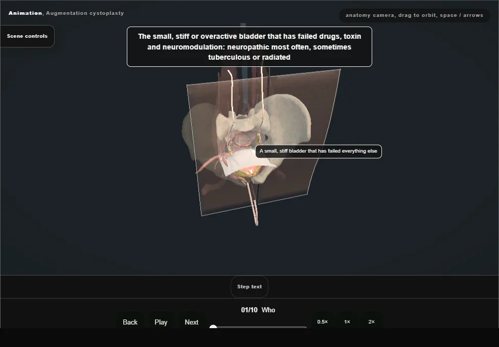 Augmentation cystoplasty. Step 1: Who. Captured frame from the interactive animation.
