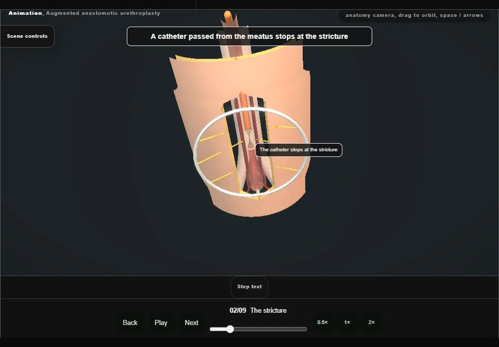Augmented anastomotic urethroplasty. Step 2: The stricture. Captured frame from the interactive animation.