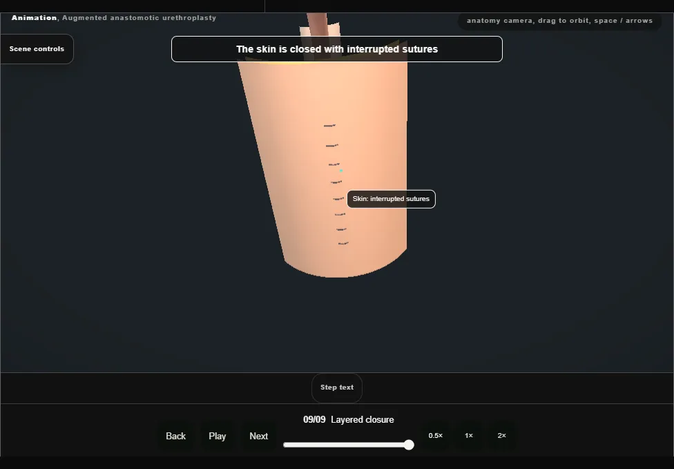 Augmented anastomotic urethroplasty. Step 9: Layered closure. Captured frame from the interactive animation.