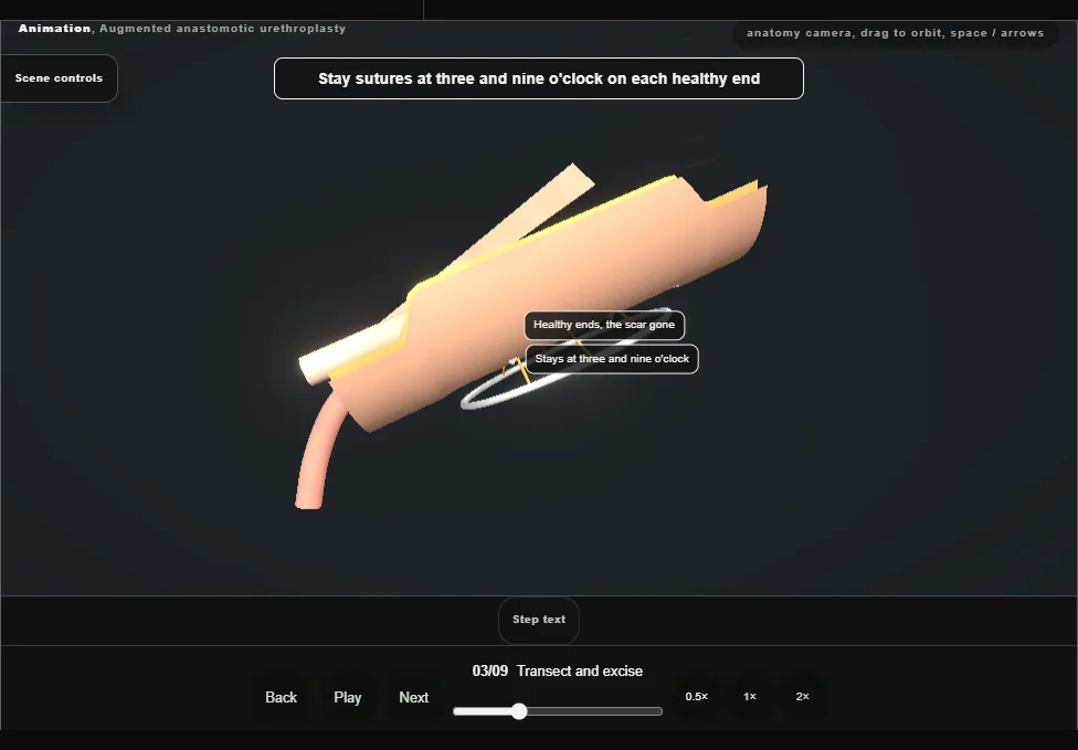 Augmented anastomotic urethroplasty. Step 3: Transect and excise. Captured frame from the interactive animation.
