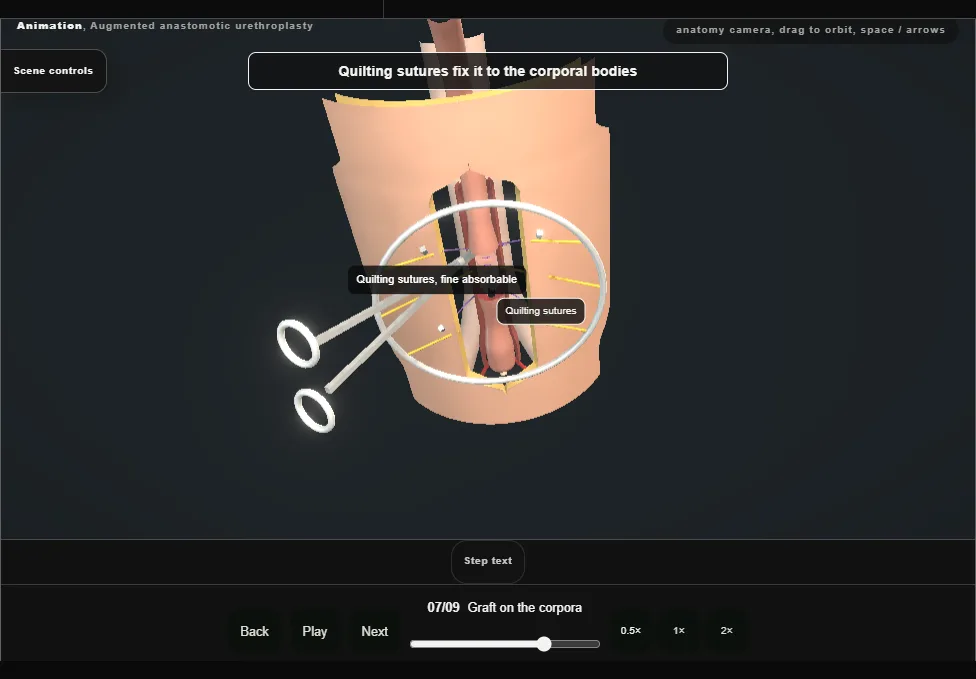 Augmented anastomotic urethroplasty. Step 7: Graft on the corpora. Captured frame from the interactive animation.